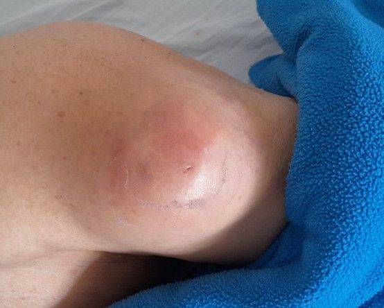 다리에 혹처럼 튀어나온 연부 조직 종양.