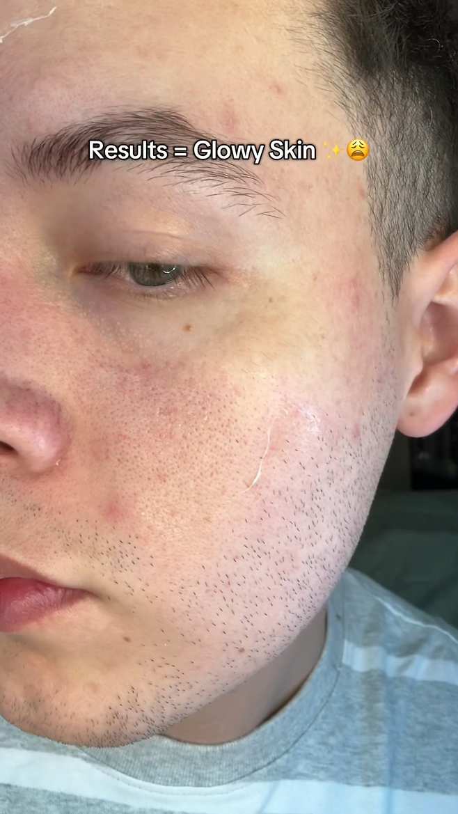 마데카솔 챌린지 비포 앤 애프터. 틱톡 @oskrrene