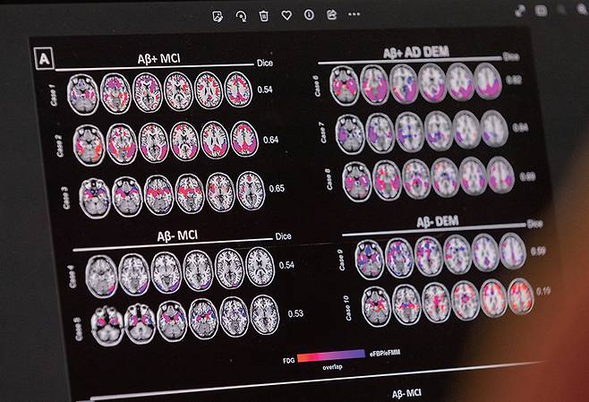 알츠하이머병 환자의 뇌 사진. ／ 로이터뉴스1