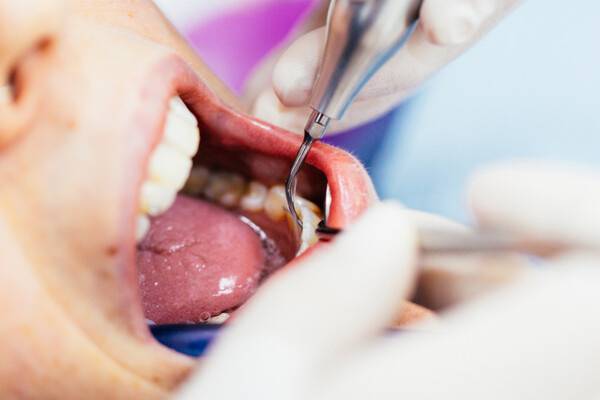 치석제거술(스케일링)은 치주질환을 예방할 수 있는 가장 효과적인 방법이다. 게티이미지