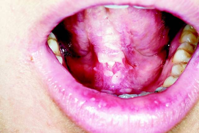 구강 궤양./클립아트코리아/