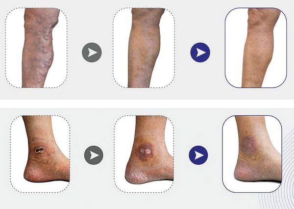 4기 이상 중증 하지정맥류 환자를 초음파 유도하 혈관경화요법으로 치료한 이후 경과를 보여주는 모습.  출처 2023 아시아심장혈관흉부외과학회 포스터 발표(김병준 레다스 흉부외과 국제연구소) 김병준 레다스 흉부외과의원 제공