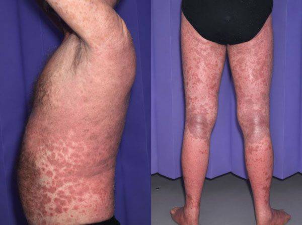 영국의 60대 남성이 특정 약물을 복용한 후 온몸에 발진이 올라온 증상을 겪은 사례가 보고됐다./사진=큐레우스