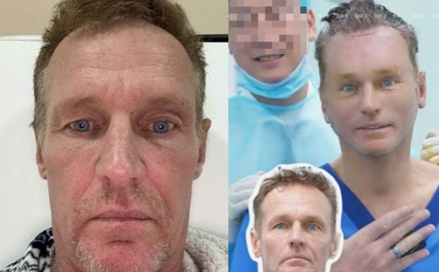 베트남에서 57세 호주인 제이슨 해리건이 얼굴 성형 수술 받는 영상이 8000만 조회수를 기록하며 소셜미디어 스타가 됐다. [사진출처 = VN익스프레스]