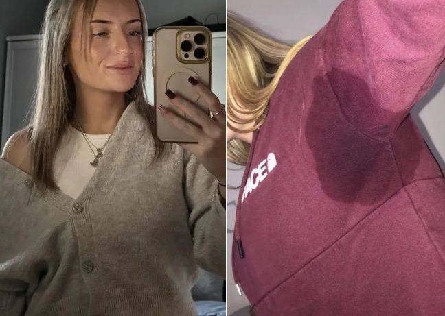 심한 다한증을 앓고 있는 20대 영국 여성이 다한증에 대한 관심을 호소했다. 출처=더선