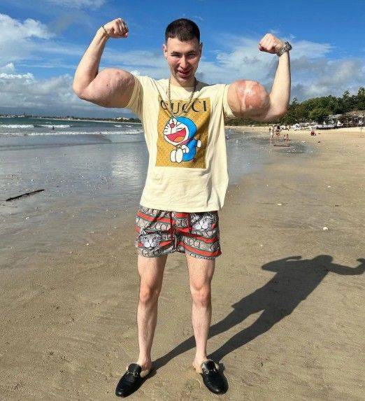 [뉴시스]종합격투기 선수인 키릴 테레신(29남)은 자신의 팔 정맥에 화학 물질인 '신톨'을 수년간 직접 주사해왔다. (사진 = kirilltereshin96 인스타그램 캡처) *재판매 및 DB 금지