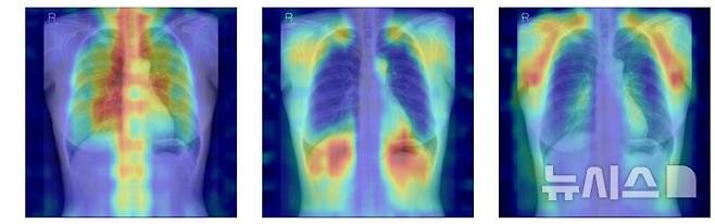[서울=뉴시스] 흉부X선에서 파운데이션 모델이 골다공증 판독을 위해 주목한 영역을 시각화한 이미지. (사진= 서울대병원 제공)