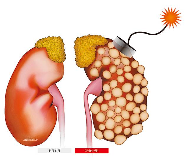 정상 신장(왼쪽)과 다낭성 신장/클립아트코리아/