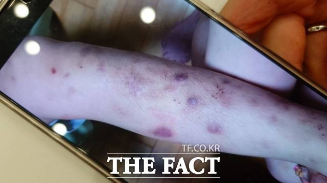 A씨는 자폐 증상이 있는 첫째 아이가 B씨와 지내면서 아픈 곳이 있어도 제대로 치료를 받지 못한 채 방치 상태에 놓여있었다고 주장했다. A씨가 아이의 다리 상태를 촬영한 사진을 보여주고 있다./최현정 기자