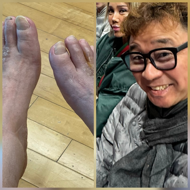 김송이 25년째 하반신 마비와 싸우고 있는 남편 강원래의 발 상태를 공개했다.사진=김송 sns