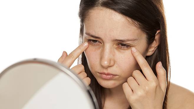 다크서클은 눈밑 지방 돌출 또는 꺼짐으로 인한 그림자 때문인 경우가 흔하다｜출처: 게티이미지뱅크