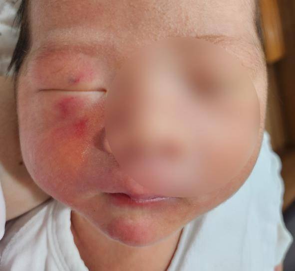 생후 4일 된 영아 얼굴에 상처. 연합뉴스