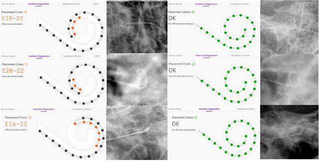 SmartNav가 탐지한 전극 끝말림 확인과 재삽입 후 정상화된 모습,  X-ray와 함께 이를 시각적으로 제시했다.