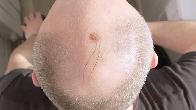 A head suffering from hair loss [JOONGANG ILBO]