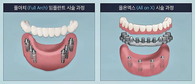 임플란트 치료 시 전체 치아 회복 방식으로 ‘풀아치(Full Arch)’와 ‘올온엑스(All on X)’를 고려한다 /그래픽=김남희