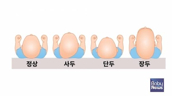 그림으로 확인할 수 있는 사두증과 단두증, 장두증의 차이. ⓒ임신영