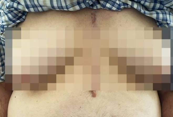 고혈압약 부작용으로 유방이 커진 76세 남성. 뉴잉글랜드의학저널