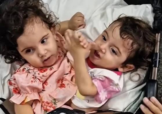 브라질 샴쌍둥이 자매의 18개월 되던 당시 사진. 더선