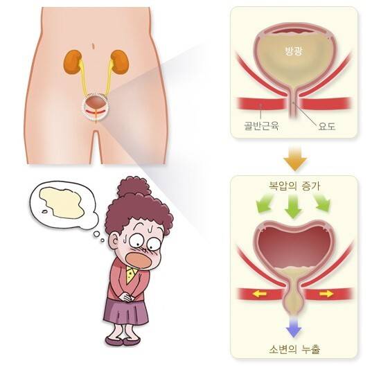 복압요실금의 발생기전. 질병관리청 국가건강정보포털