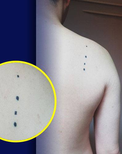 성기훈 교수는 방사선 치료에 사용되는 마킹을 점점 지워지는 문신으로 대체하는 방법을 찾기 위해 직접 몸에 문신을 하기도 했다./사진=성기훈 교수 제공