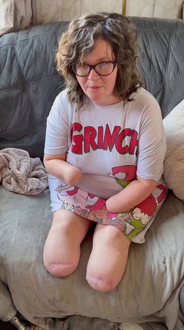 영국의 한 여성이 연쇄상구균 감염으로 유발된 패혈성 쇼크로 사지 절단까지 하게 된 사연이 전해졌다./사진=데일리메일