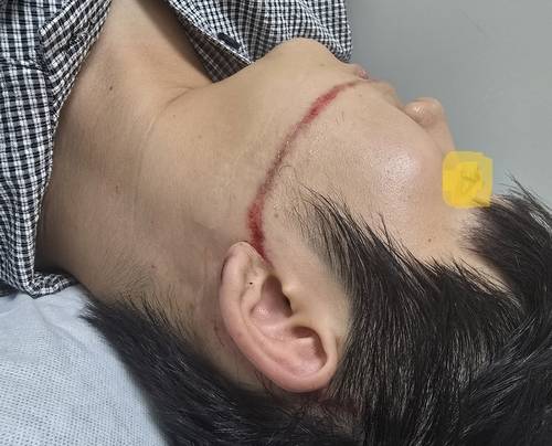 물축제 공연중 워터건에 맞아 얼굴을 크게 다친 피해자 [피해자 측 제공]