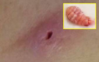 여행을 다녀온 후 피부에 이상 증상이 생긴다면 유충에 감염된 상태일 수 있다./사진=임상의학 증례 보고 저널