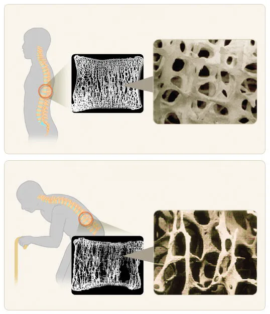 골밀도가 정상인 사람(위)과 골다공증 환자의 뼈 상태를 비교한 모습. 대한골대사학회 제공