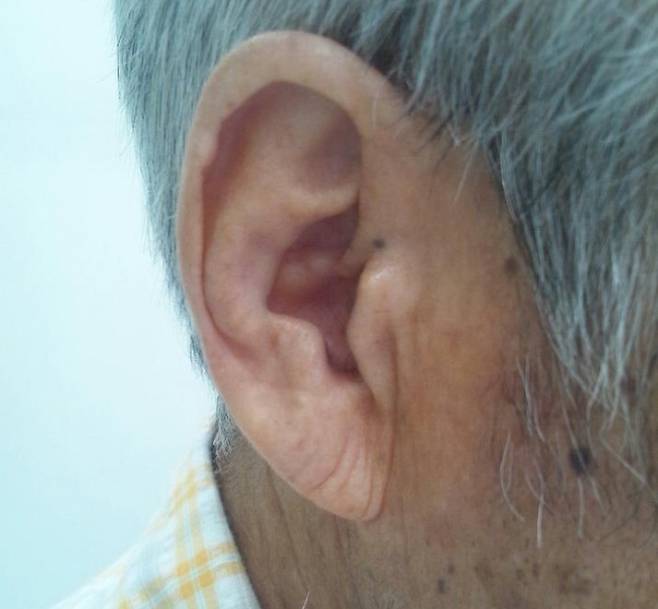 일본인 협심증 환자에게서 관찰된 귓불 주름. 위키피디아