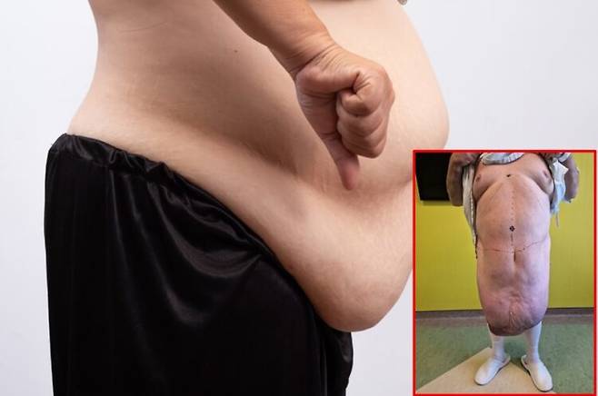 데스모이드종양은 결합조직에서 발생하는 매우 드문 비암성 종양이다. 배경사진=게티이미지뱅크/오른쪽 하단 사진=Journal of Surgical Case Reports