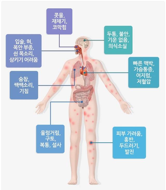 아나필락시스 증상. 질병관리청
