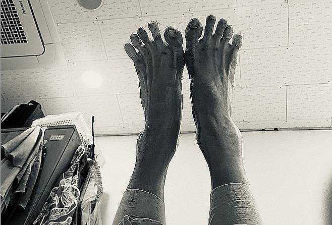 공유민 광주시립발레단원의 발. 발톱 곳곳에 피멍이 들어있다.