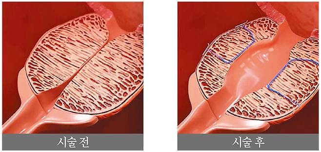프로게이터는 'l'자 형태로 전립선을 묶었던 기존 결찰술과 달리 하나의 결찰사를 'ㄷ'자 형태로 고정하는 최소 침습 시술법이다. /나인비뇨의학과의원 제공