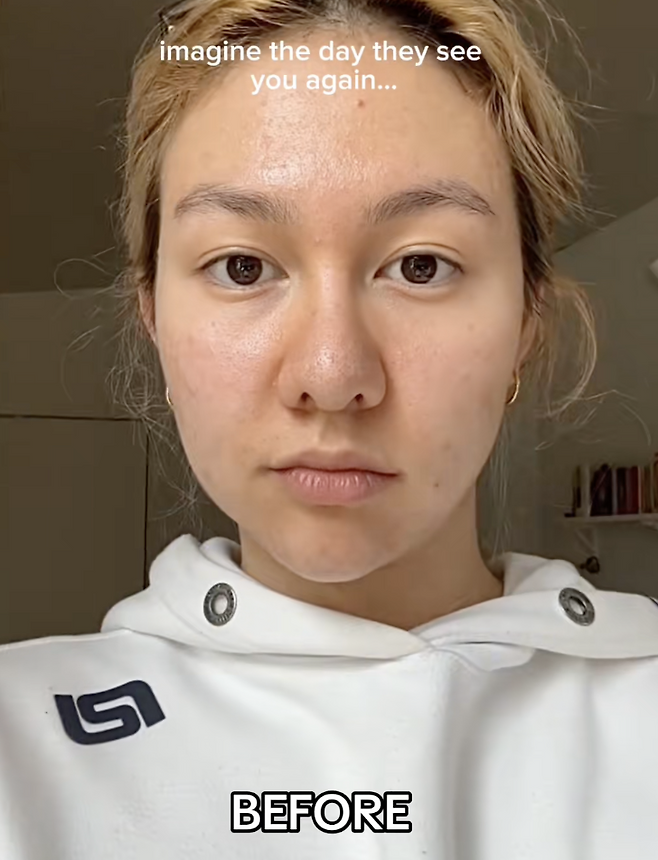 틱톡에서 바이럴 중인 이소티논의 코 미용 효과 ‘accutane nose’. 틱톡 @abigailpalmr