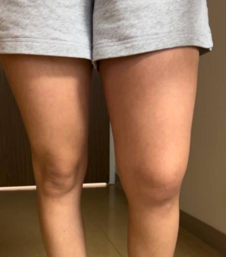 스피닝 후 횡문근융해증이 발생하면서 한 쪽 허벅지가 부어오른 모습. 사진=clinical case reports