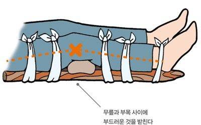 [대구=뉴시스] 전문가들은 부상 직후 정확한 진단 전까지는 RICE 요법을 적용해야 한다고 조언한다. (사진=박종수 율하바른정형외과 제공) 2026.01.24. photo@newsis.com *재판매 및 DB 금지