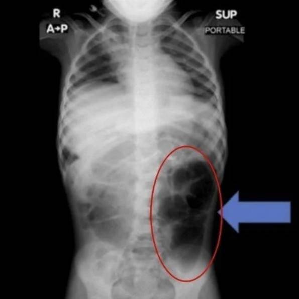 위장에 포착된 머리카락 덩어리 [큐레우스 갈무리]
