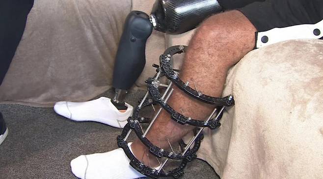 다리 절단 수술을 받은 조던 치에도지. /사진=영국 BBC 갈무리