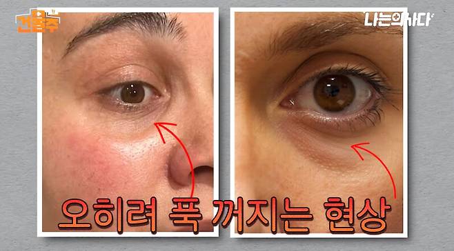 눈 밑이 불룩하게 튀어나온다고 해서 무작정 눈 밑 지방을 제거하기보다는 눈 구조와 노화 상태에 맞는 개선 방법을 찾아야 한다. /사진=유튜브 채널 '나는 의사다'