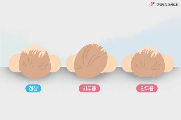 자세형 사두증의 유형. 한림대 동탄성심병원 제공