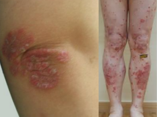 건선의 가장 특징적인 증상은 은백색의 두꺼운 각질로 덮인 경계가 뚜렷한 붉은 발진이다. 처음에는 좁쌀 같은 작은 발진으로 시작하지만, 시간이 지나면서 주변 병변과 합쳐지거나 커지며 넓은 부위로 퍼진다. 병변은 주로 팔꿈치, 무릎, 두피, 엉덩이 등 마찰이나 자극을 많이 받는 부위에 나타난다. /사진=파이낸셜뉴스 DB