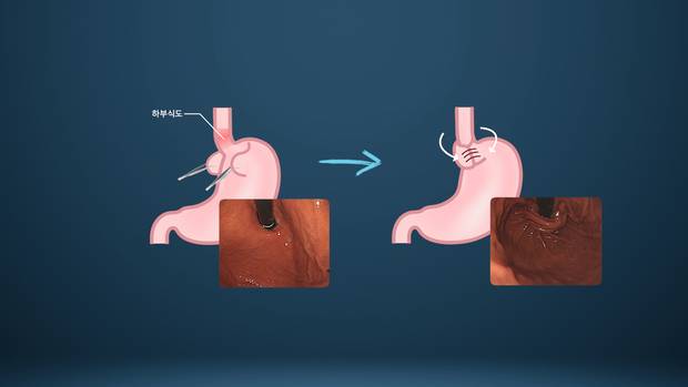 참고용/항역류 수술 그래픽  : 항역류 수술.  위 상부 조직으로 식도 하부를 감싸 위 안의 내용물 역류를 막는다./ 서울경제TV ‘지금, 명의’ 캡처