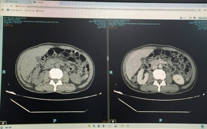 간에 농양이 생긴 남성의 CT 사진. 사진=제트 뉴스