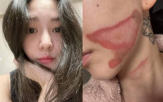 걸그룹 AOA 출신 권민아가 피부 시술을 받다 얼굴에 2도 화상을 입은 사연을 전했다. [사진출처 = 인스타그램]