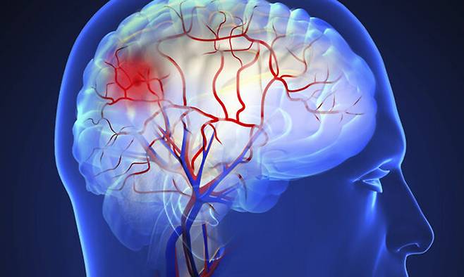 뇌 자기공명영상(MRI)을 수 초 만에 판독해 환자가 얼마나 긴급하게 치료받아야 하는지 예측해주는 인공지능(AI) 기반 모델이 개발됐다.&nbsp;클립아트코리아