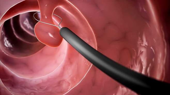 내시경 도중 발견된 '용종'은 반드시 제거하는 것이 '암'을 막는 지름길이다|출처: 클립아트코리아