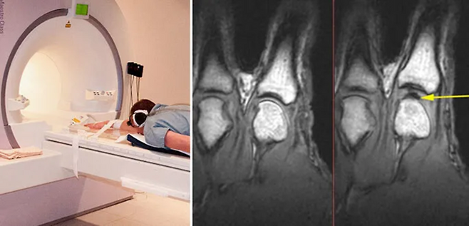 이렇게까지 해야…했다. 모든 건 거품형성파의 승리를 위해서다. 왼쪽은 관절을 MRI로 촬영하는 모습. 오른쪽은 관절을 잡아당길 때 발생하는 빈 공간. [캐나다 앨버타대학]
