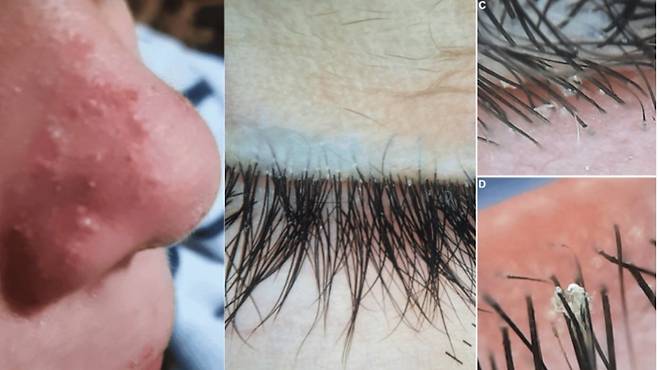 안면 구진, 농포, 눈꺼풀 가려움을 호소하던 7세 소년의 얼굴에서 모낭충이 발견됐다. 의료진은 모낭충증을 문제 증상의 원인으로 진단했다. 사진=큐레우스(Cureus)