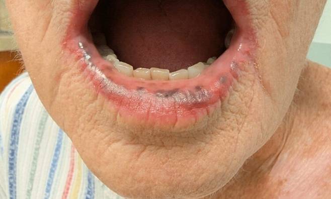 라우지에 훈지커 증후군으로 인해 입안 점막에 반점이 생긴 모습. 사진=큐레우스(Cureus)