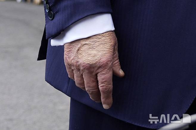 [워싱턴=AP/뉴시스] 지난 15일(현지 시간) 도널드 트럼프 대통령이 백악관에서 기자들과 질의응답을 하고 있는 가운데 손에 멍 자국을 가리기 위한 화장품이 덧발려져 있다. 올해 79세인 트럼프 대통령이 종아리 붓는 증상으로 종합 검진한 결과 만성 정맥부전을 진단받았다. 2025.07.18.